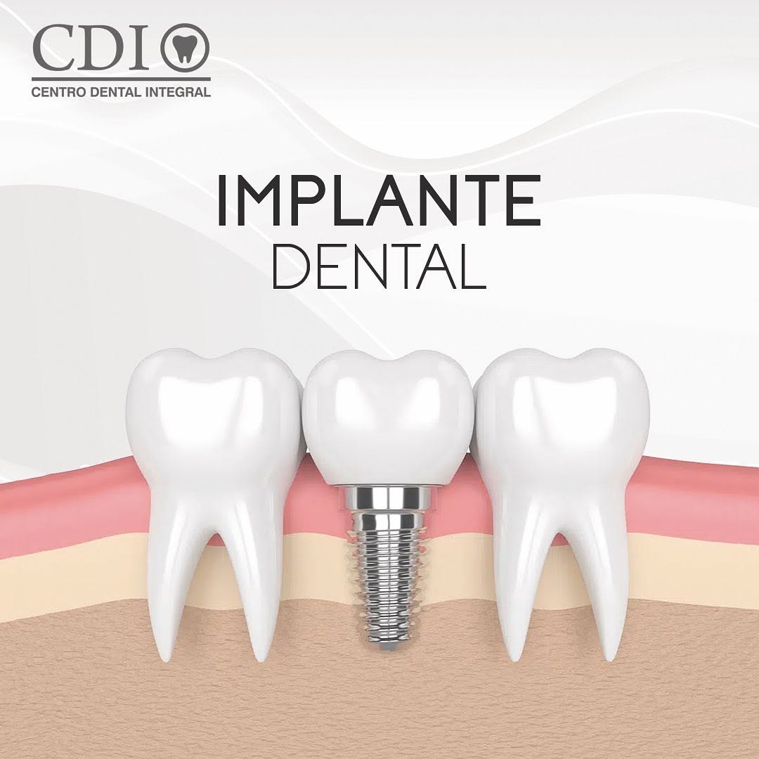 Promo implante dental
